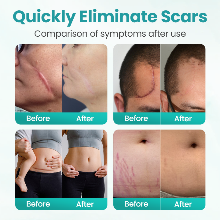 Timilk® EliteAloe ScarSolve Spray
