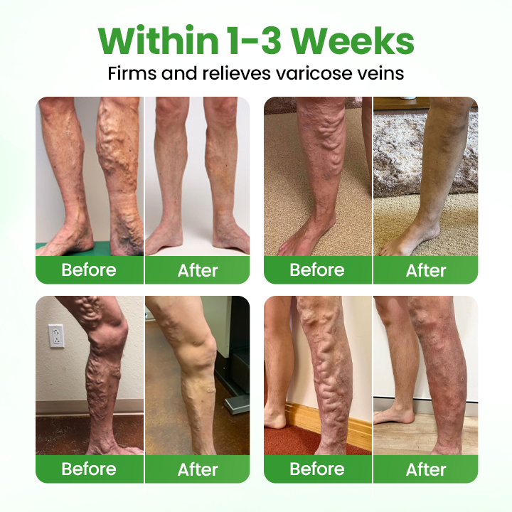 Healrize® VeinHeal Microneedle Patch✨