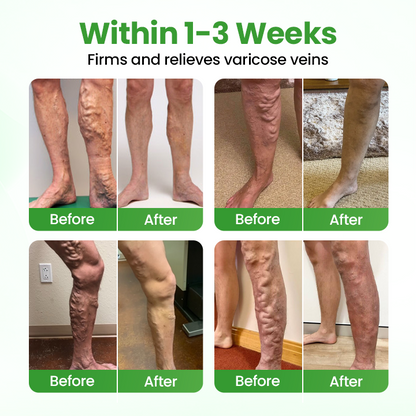 Healrize® VeinHeal Microneedle Patch✨