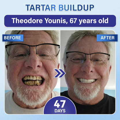 Your Smile🦷Ceoerty® Tooth & Gum Repair Fast-Dissolving Microneedle Patch✨ (𝟓-𝐢𝐧-𝟏 💎 𝐑𝐞𝐛𝐮𝐢𝐥𝐝 𝐄𝐧𝐚𝐦𝐞𝐥 & 𝐃𝐞𝐧𝐭𝐢𝐧 • 𝐒𝐭𝐫𝐞𝐧𝐠𝐭𝐡𝐞𝐧 𝐆𝐮𝐦𝐬 • 𝐄𝐫𝐚𝐝𝐢𝐜𝐚𝐭𝐞 𝐓𝐚𝐫𝐭𝐚𝐫 & 𝐎𝐝𝐨𝐫 • 𝐖𝐡𝐢𝐭𝐞𝐧𝐢𝐧𝐠 • 𝐒𝐭𝐨𝐩 𝐓𝐨𝐨𝐭𝐡 𝐒𝐞𝐧𝐬𝐢𝐭𝐢𝐯𝐢𝐭𝐲)