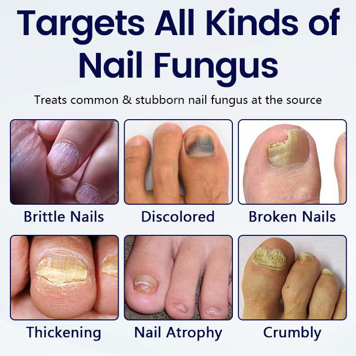 Timilk® Anti-Fungal Nail Repair Patch🔥(A)