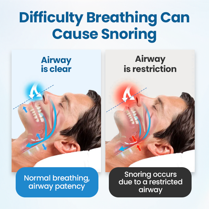 Timilk® SnoreLess Nasal Breather (A)