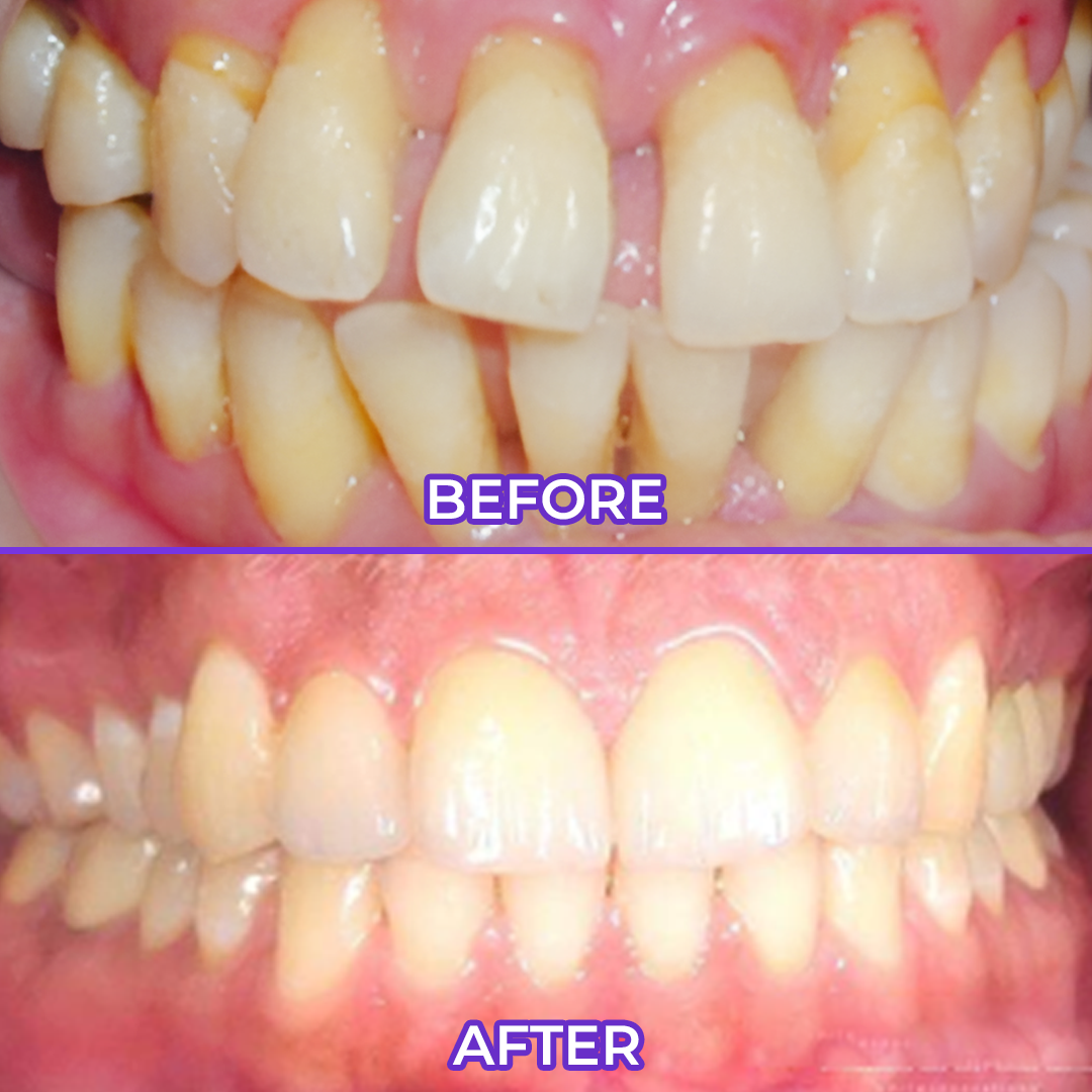 Biancat® SensiGum Fluoride Toothpaste✨